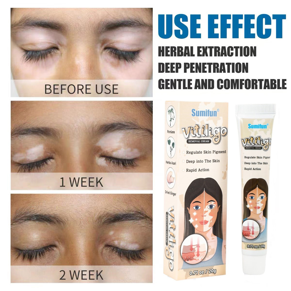 BeautyOne Vitiligo Removal Cream vitiligo skin treatment