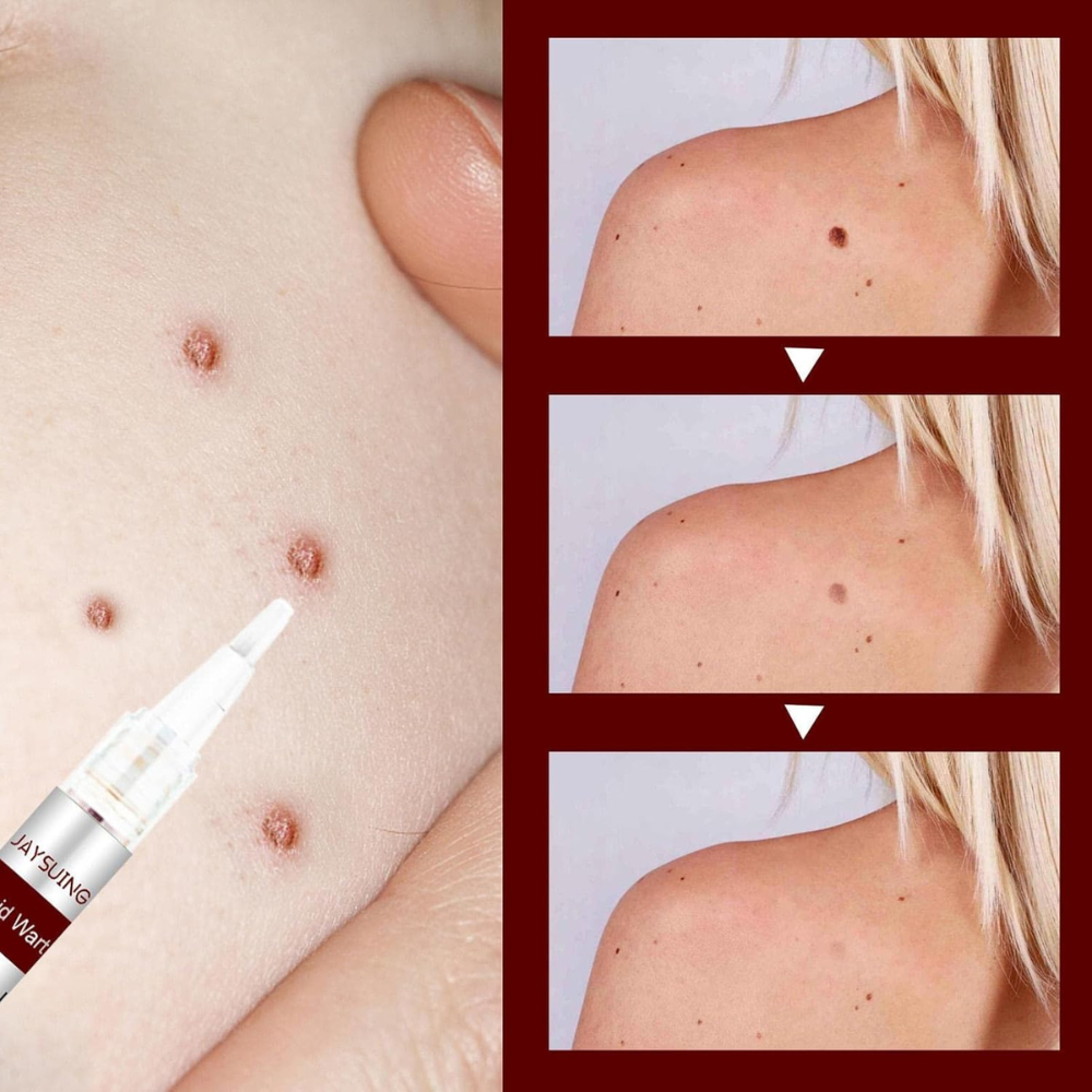 Liquid Wart and Skin Tag Removal
